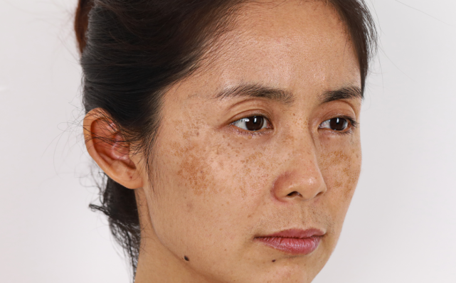 色斑像生了锈的铁皮,粉底都遮不住不仅肤色暗黄,粗糙显老但就在2个月