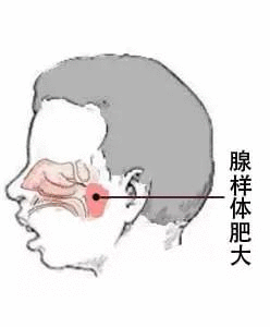 腺樣體切除的同時扁桃體需要一起切除嗎