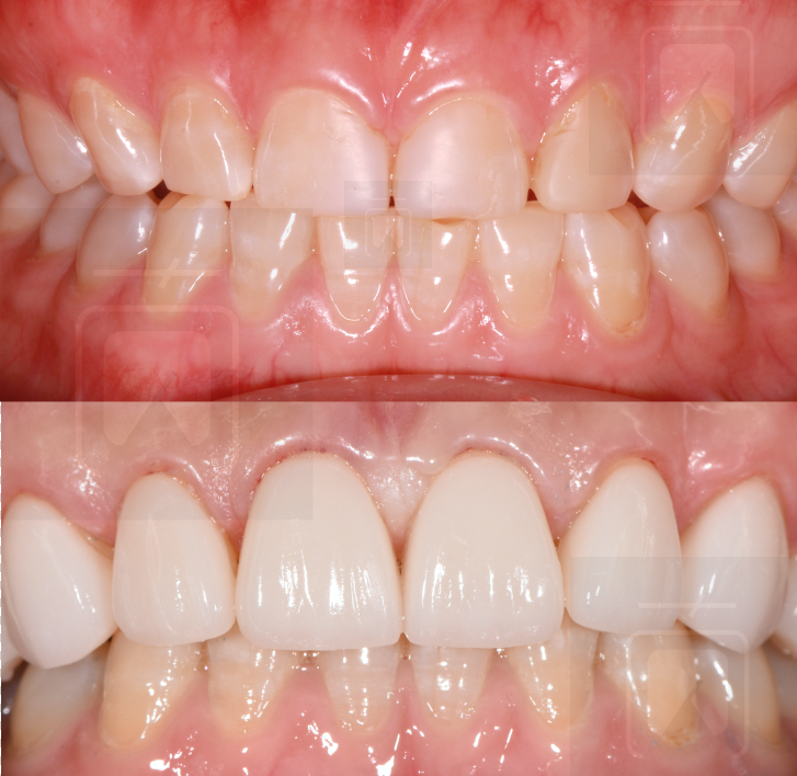 瓷贴面的缺点不是脆弱其实是