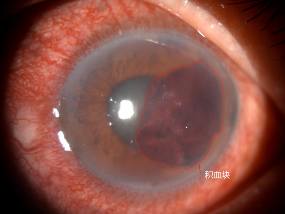 东莞有人放鞭炮炸伤眼球,医生提醒:不要揉不要用清水洗,立即就医