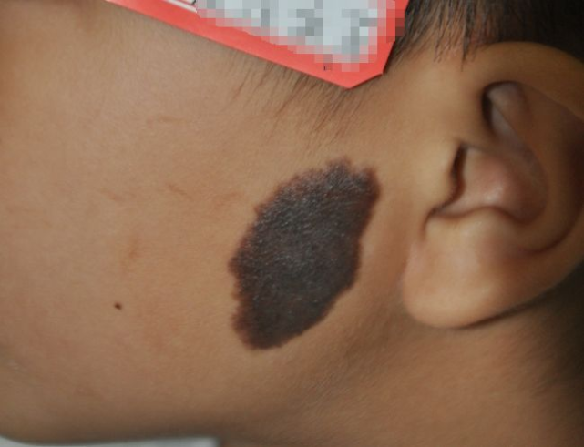 胎记是怎么来的有哪些颜色