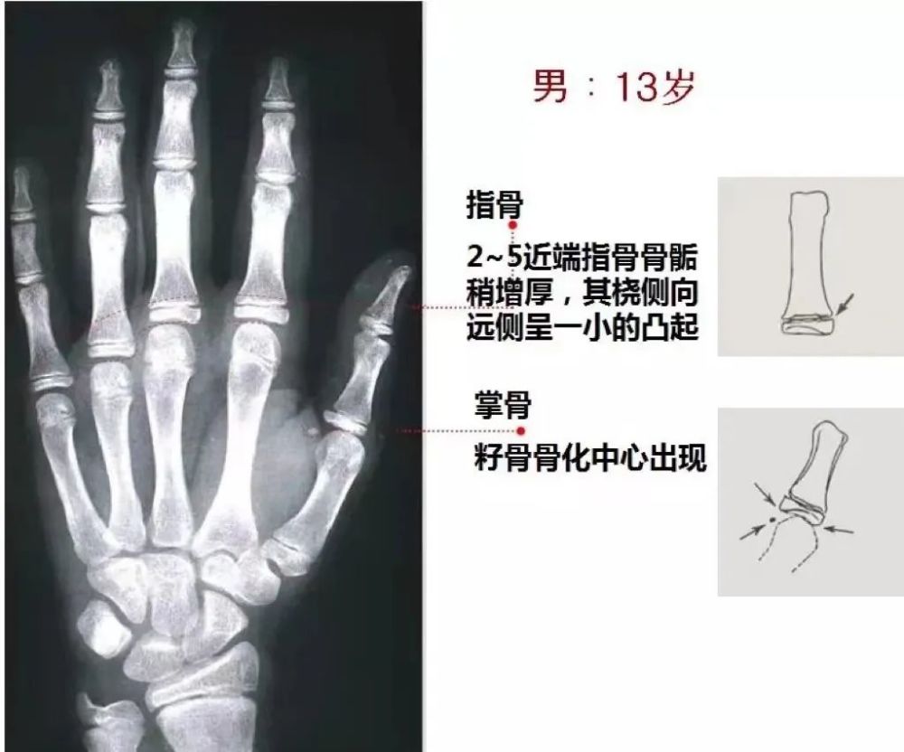 骨科精讀收藏高清骨齡解析圖譜骨科醫生臨床必備