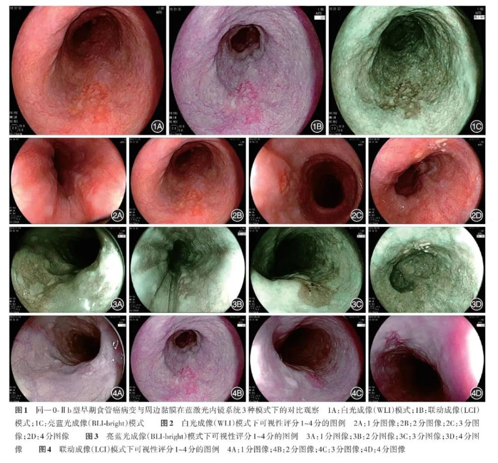 202201論著亮藍光成像與聯動成像在早期食管癌內鏡診斷中的應用價值