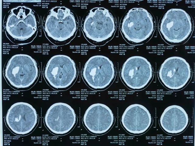 第二次ct(24时)示右侧基底节区脑出血量约40ml且破入脑室