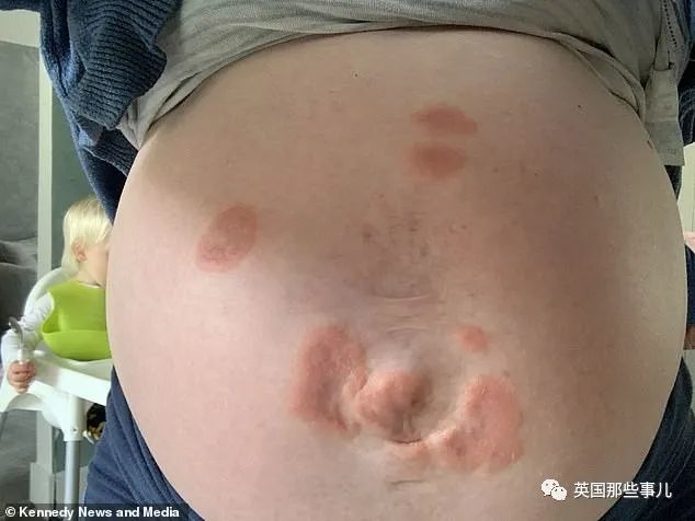 妊娠疱疹图片