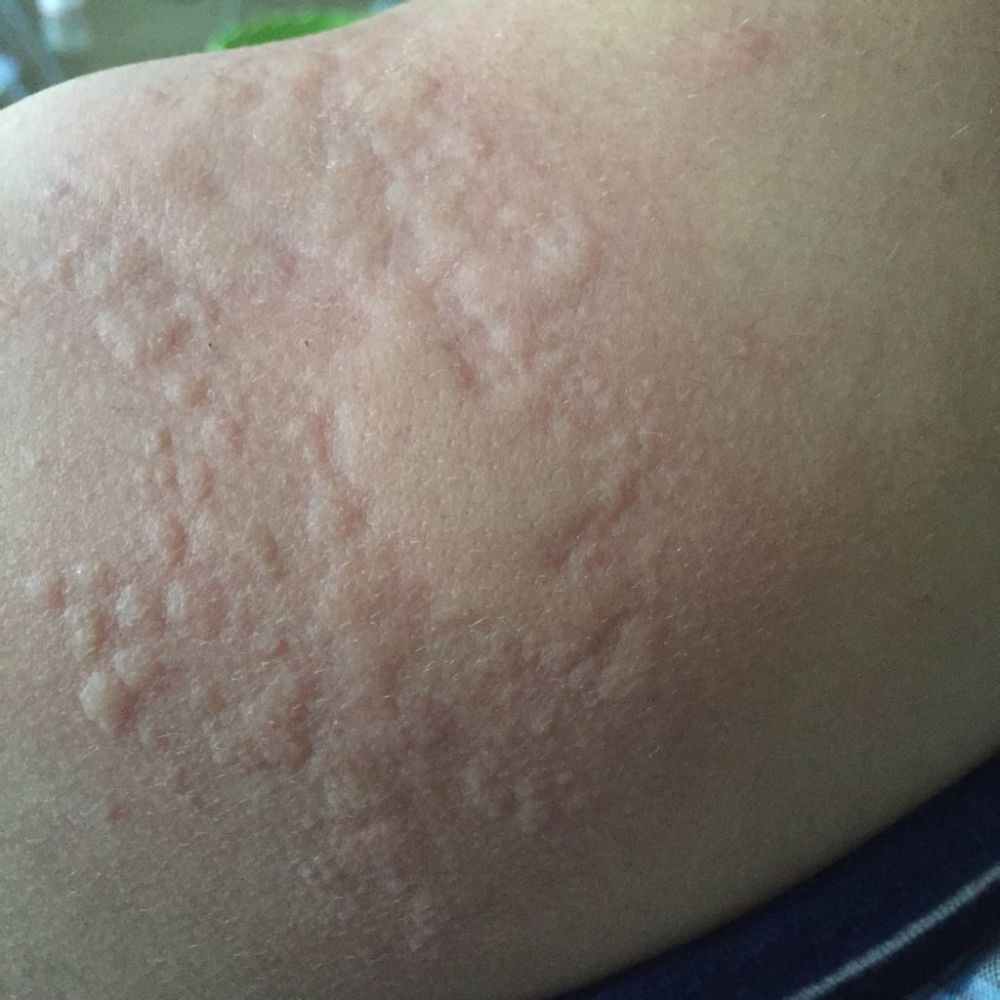 痒得不行孩子得了荨麻疹该怎么办