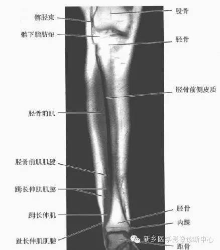 小腿部斷層解剖詳細標註