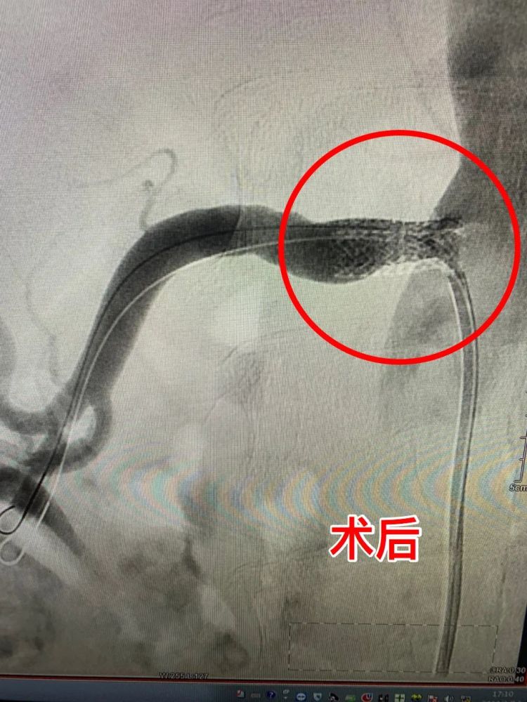 此次因高血压住了院,经过检查被确诊为"肾动脉狭窄".