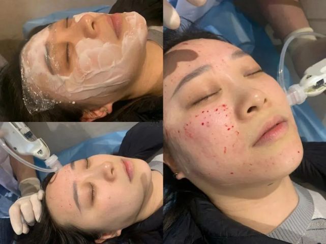 医美科普|水光针为什么要按疗程注射?
