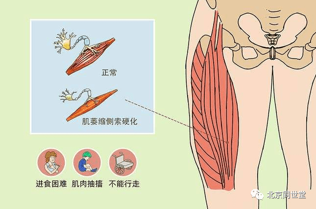 混合型運動神經元:通常以手肌無力,萎縮為首發症狀,一般從一側開始