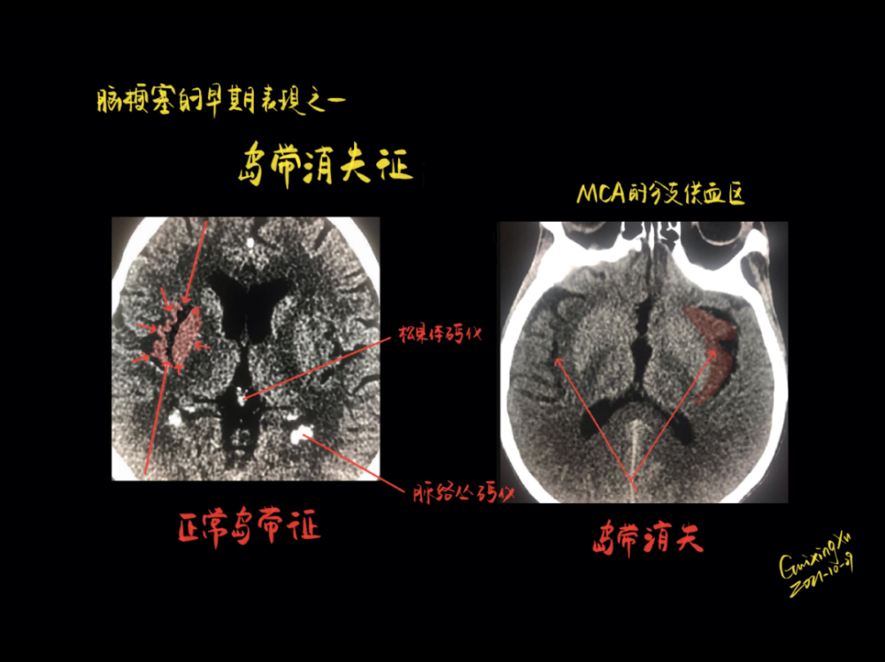 (动静脉畸形)的征象肿瘤卒中的头颅 ct 征象左颞叶血肿,导致脑干受压