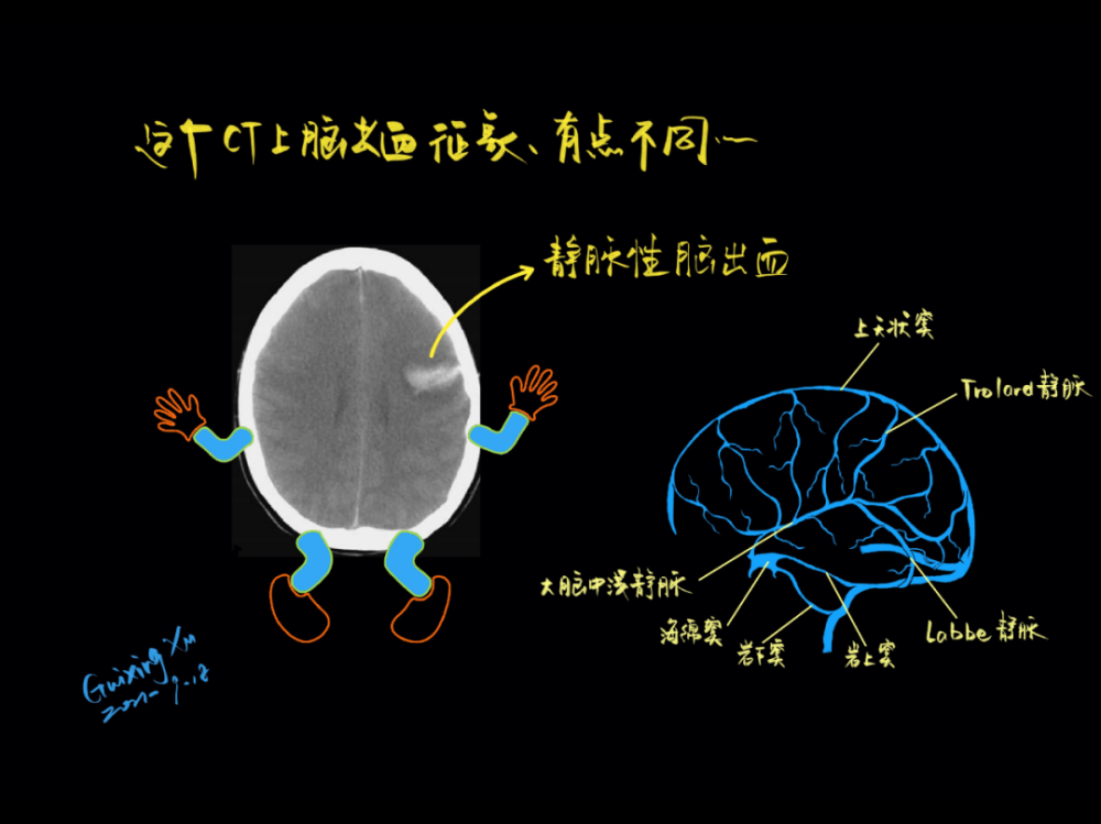 继续更新颅脑mr阅片手绘版大神版