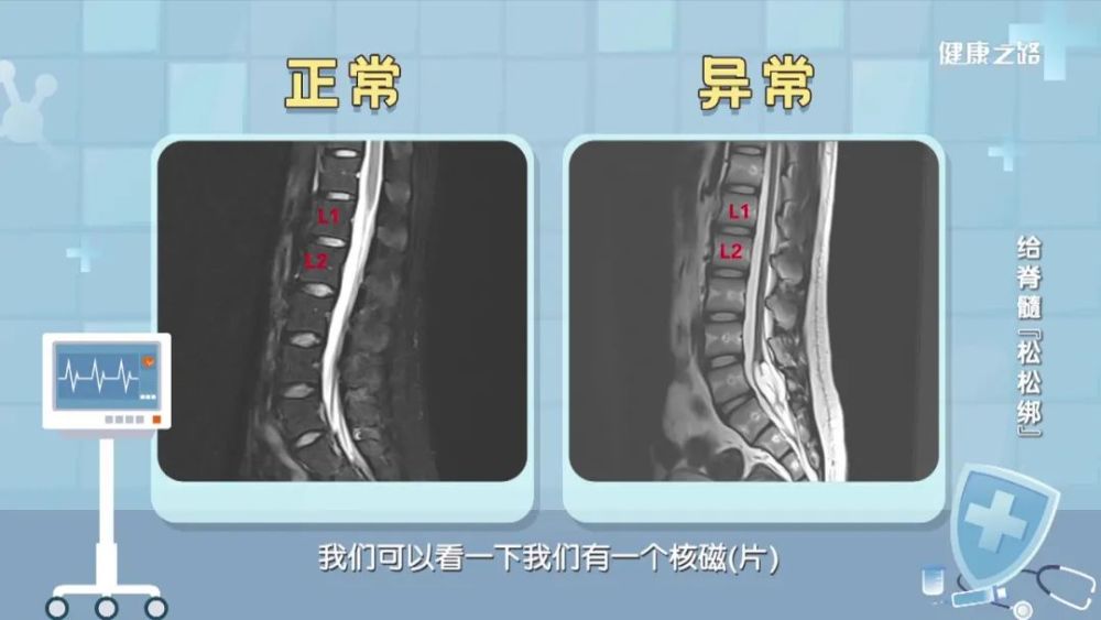 腰椎的核磁共振,是判断脊髓拴系的重要依据.