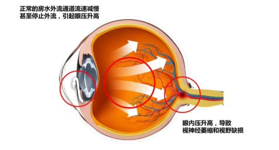 天气寒冷，谨防青光眼发生(图1)
