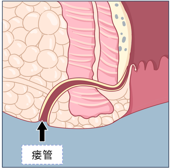 肛瘻,單純從名字來看,很多人錯誤地認為是肛門部漏大便.