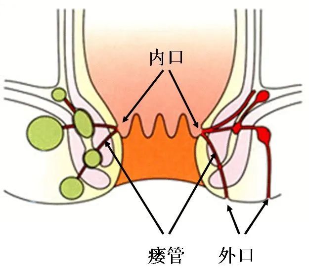 口未處理完全我們總結了令肛瘻反覆的幾個原因:許多肛瘻患者經過手術