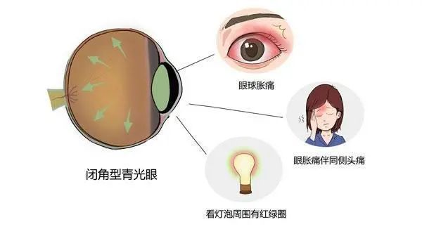 注意眼睛出现这些症状是它在像你求救