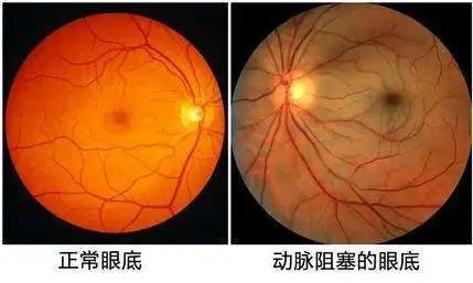 视网膜动脉阻塞两者都是表现为无痛性的突然视力急剧下降,所以有时候