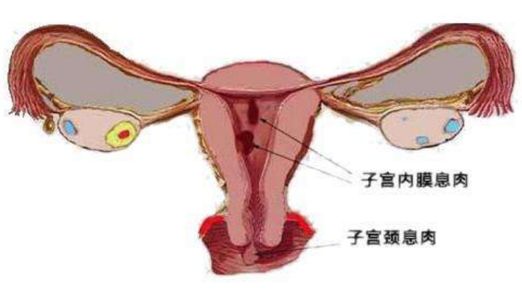 子宮內膜息肉為什麼會導致不孕有什麼方法可以解決