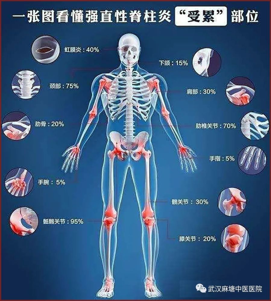 武汉麻塘中医医院专治六大类风湿病强直性脊柱炎概述