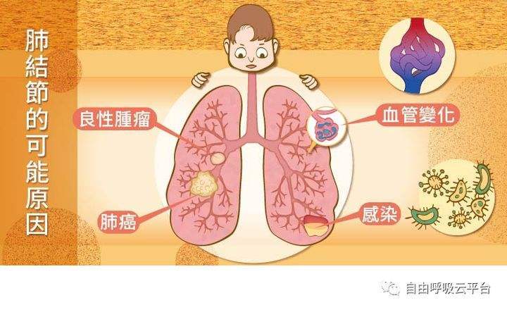 肺结节八成以上为良性无需挨一刀