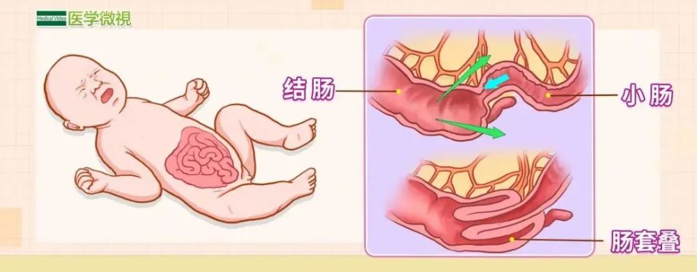 新生儿肠梗阻图片