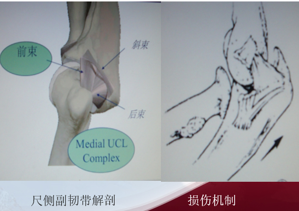 骨科精讀帶線錨釘在骨科手術中的妙用你掌握了幾種