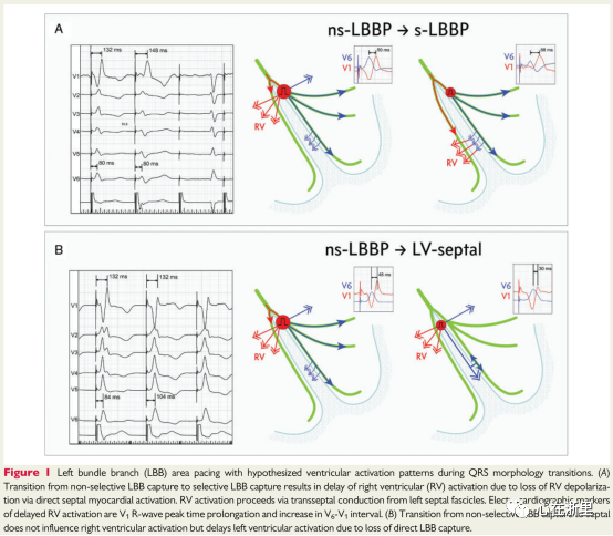 心电图左束支夺获的新标准v6v1峰间间隔