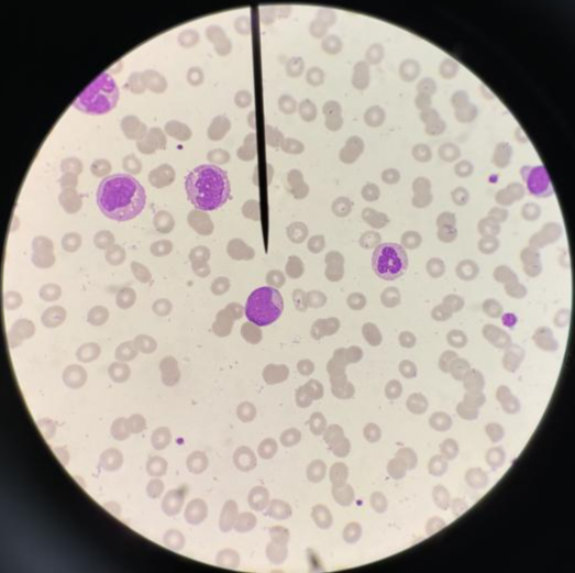 原幼样细胞呈单核样,个别细胞细胞胞浆中可见auer小体(红色箭头所指)