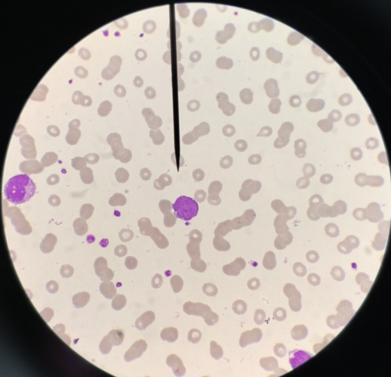 人工推片镜检,镜下血小板无聚集,数量与仪器结果相符,可见单核细胞