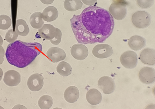 原幼样细胞呈单核样,个别细胞细胞胞浆中可见auer小体(红色箭头所指)