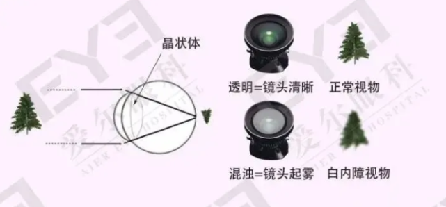 这个眼病，命中注定(图1)