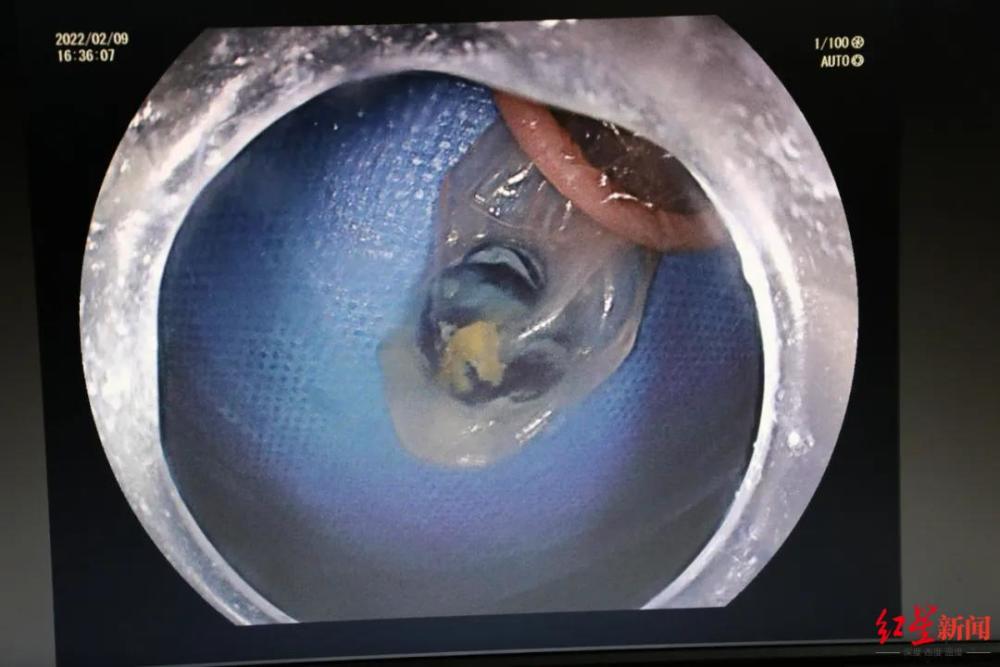4歲小女孩誤吞玻璃彈珠入胃醫生巧用這個辦法取出