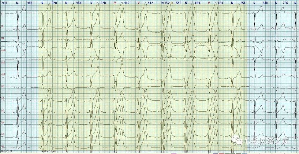 心电图病例分析62加速的室性自主心律
