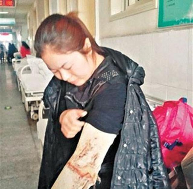 躺在手术室里的袁志豪,此时还不知道自己身上刚移植来的皮肤,是来自