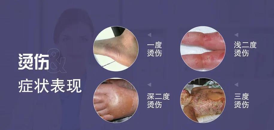 移植皮肤后,袁志豪的父亲提到,在换药时,只要一动自己,那是真的疼啊