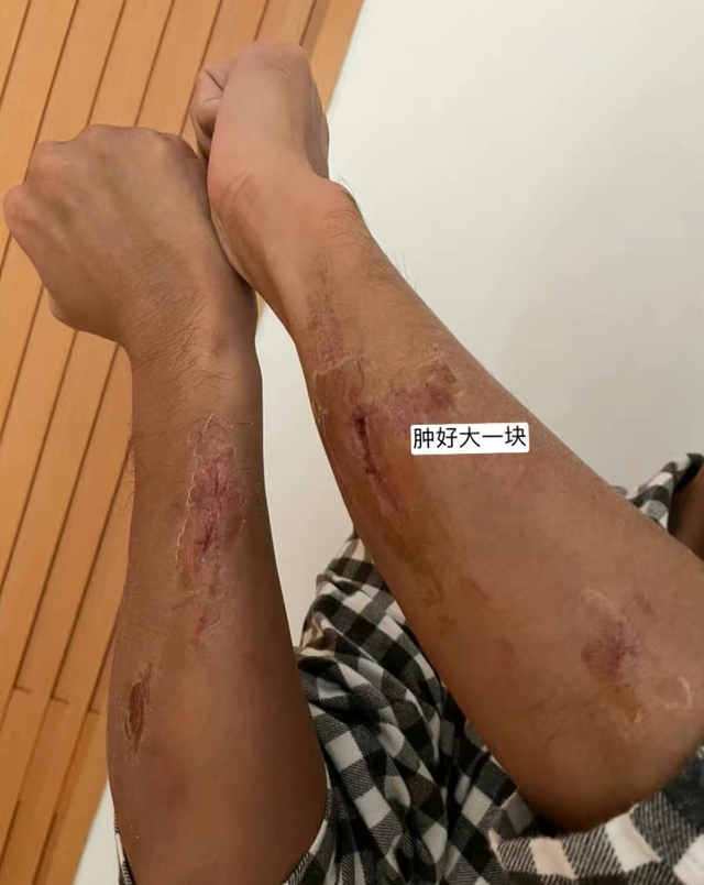 林峯拍戏意外受伤胳膊多处伤口红肿严重张馨月发文表示心疼