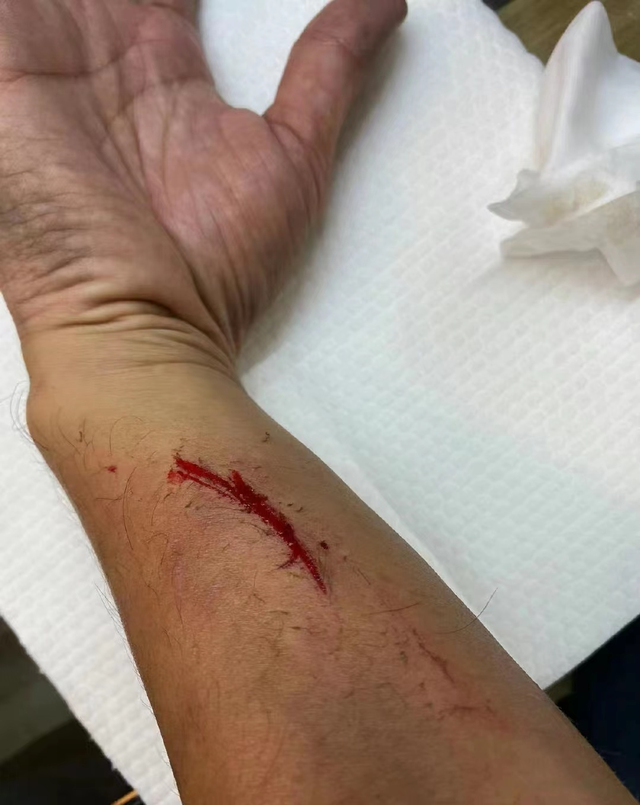 林峯拍戏意外受伤胳膊多处伤口红肿严重张馨月发文表示心疼