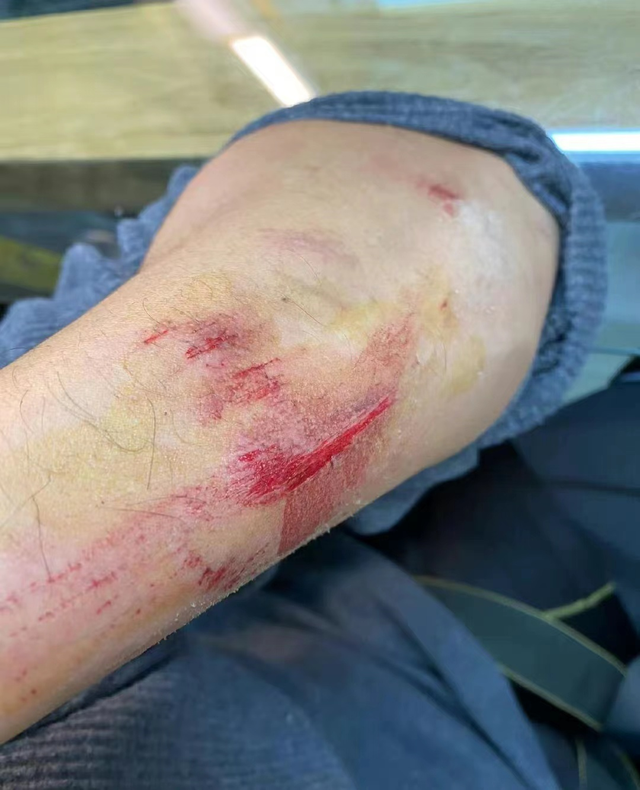 林峯拍戏意外受伤胳膊多处伤口红肿严重张馨月发文表示心疼