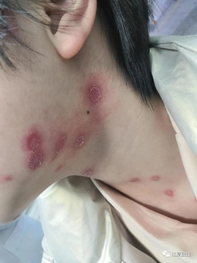 红斑|猫癣|皮肤病|皮肤瘙痒