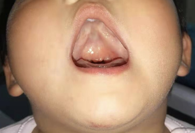 硬腭后缘切迹畸形或骨性[r2] 裂开口腔上腭粘膜完整,隐形腭裂的表现