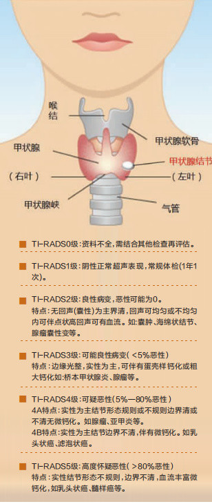 快報大健康丨我脖子也不粗啊怎麼就有甲狀腺結節了