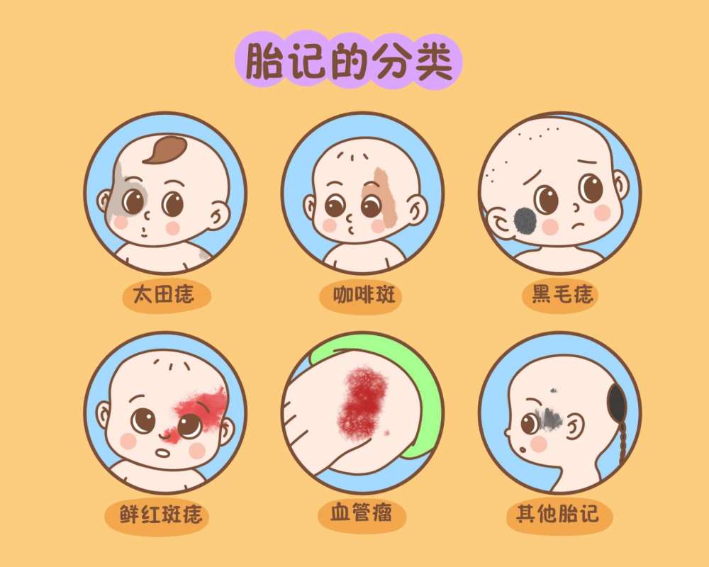 海绵状血管瘤等;色素型胎记主要是与皮肤色素变化有关,常见的有蒙古斑