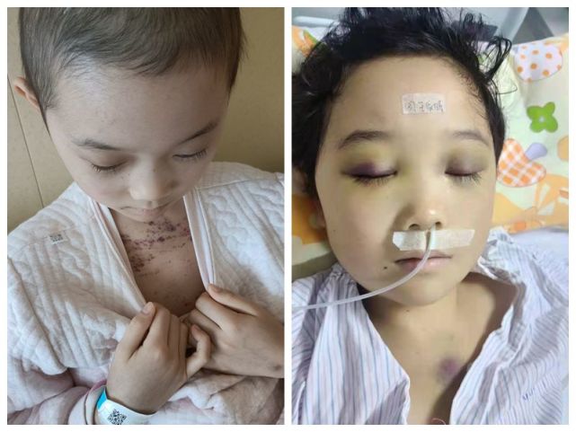 河南一9岁女孩患血癌皮肤因出血导致发黑如今无药可吃陷入困境