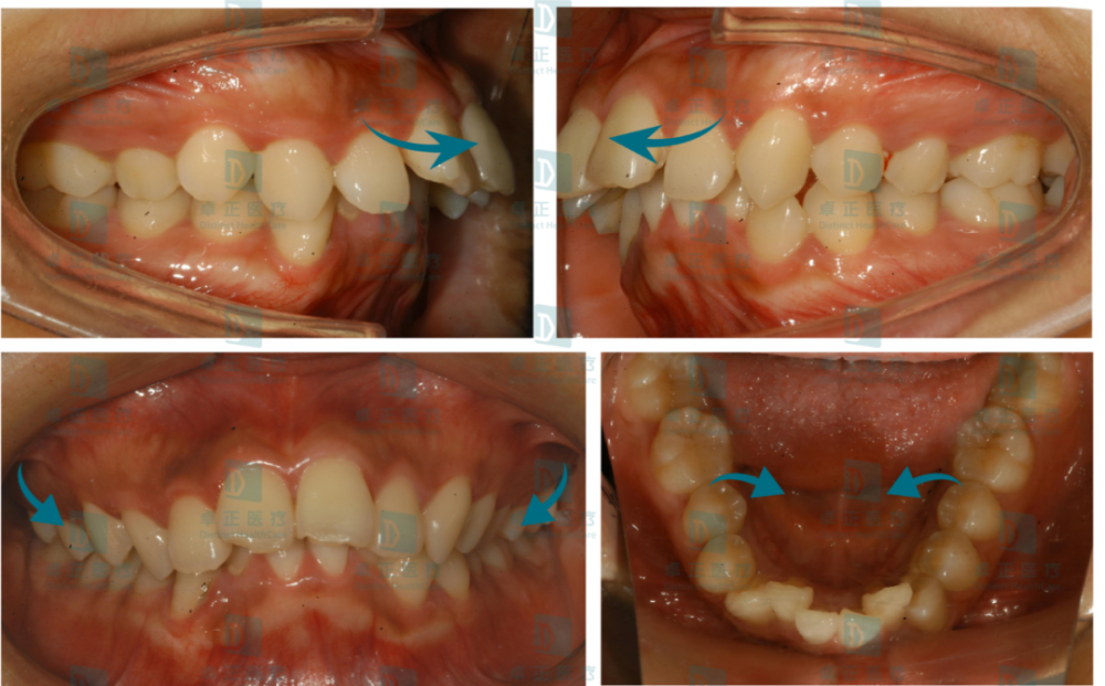 从上面的动图可以看到,失去内侧的舌体占位后,外侧的肌肉会向内压缩牙
