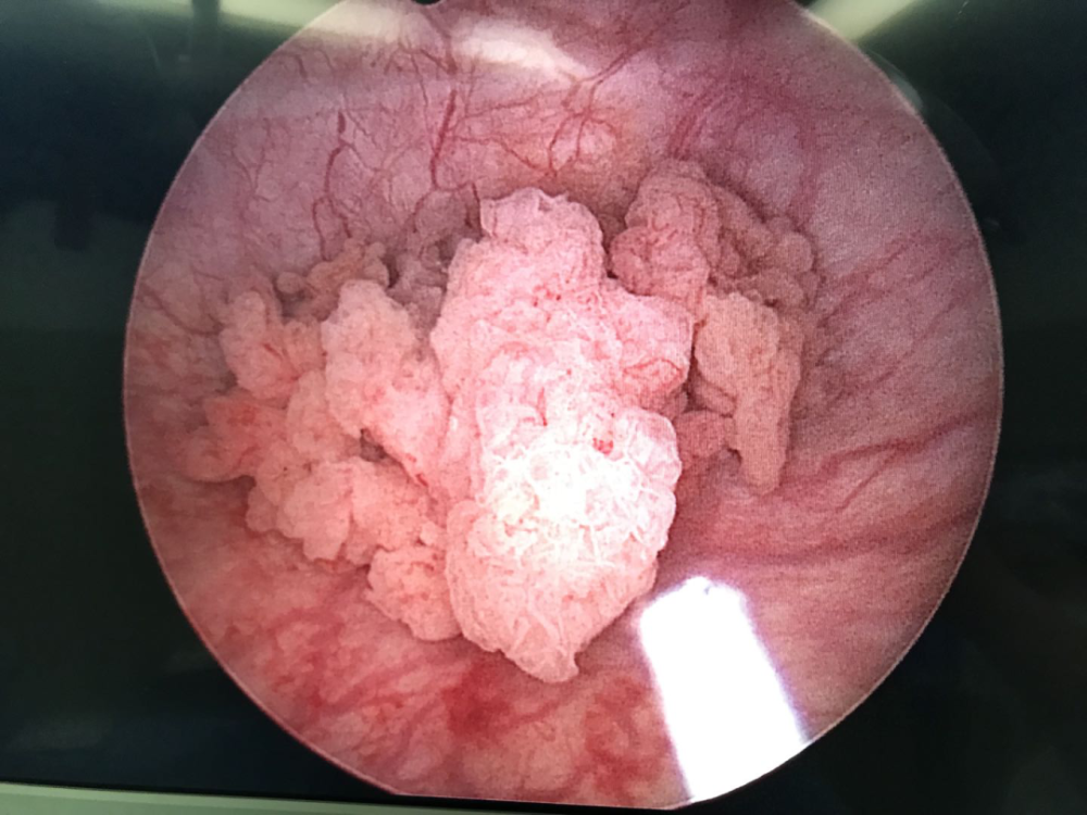 典型膀胱肿瘤表现:菜花样新生物膀胱肿瘤膀胱肿瘤是最常见的泌尿系统