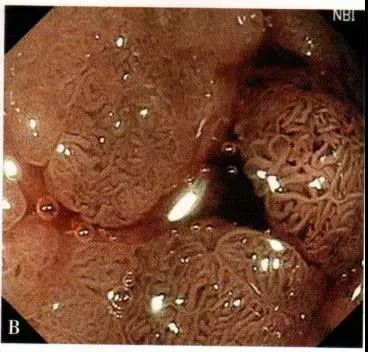 大咖总结内镜下识别早期大肠癌这些很关键