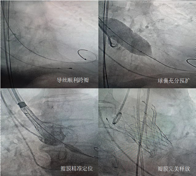 开启心门重获新生我院成功实施第一例经导管主动脉瓣植入术tavr