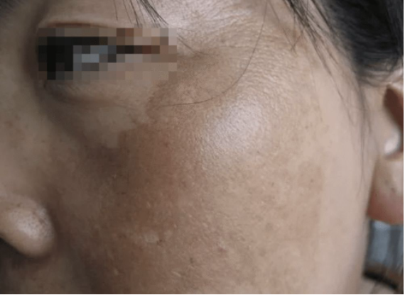 7,黄褐斑黄褐斑也叫肝斑,可见黄褐斑和肝脏有很大关系.