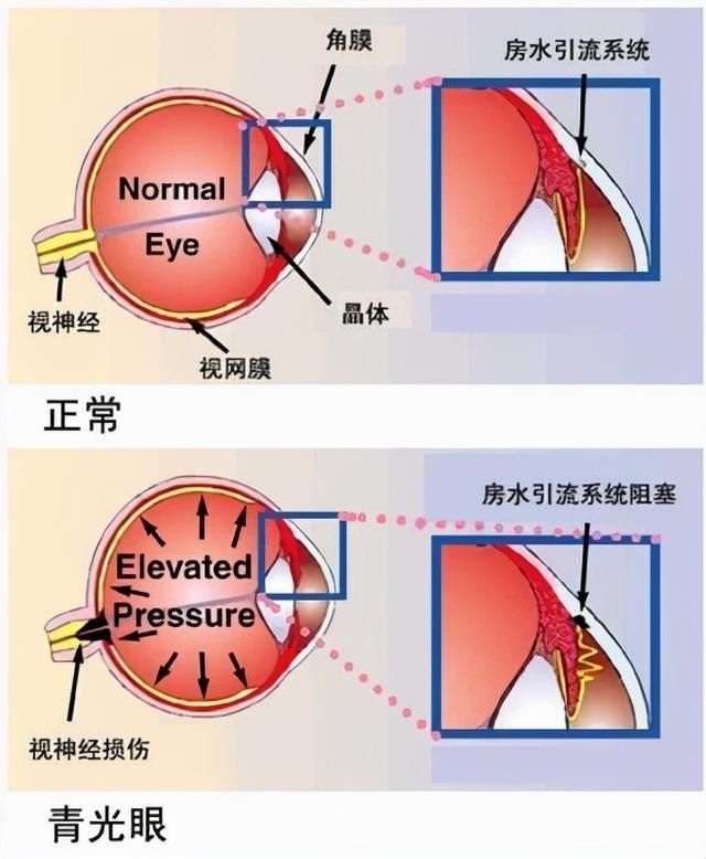 目前病因未明,但与眼压,杯盘比(c/d), 家族史,年龄,种族,近视和影响